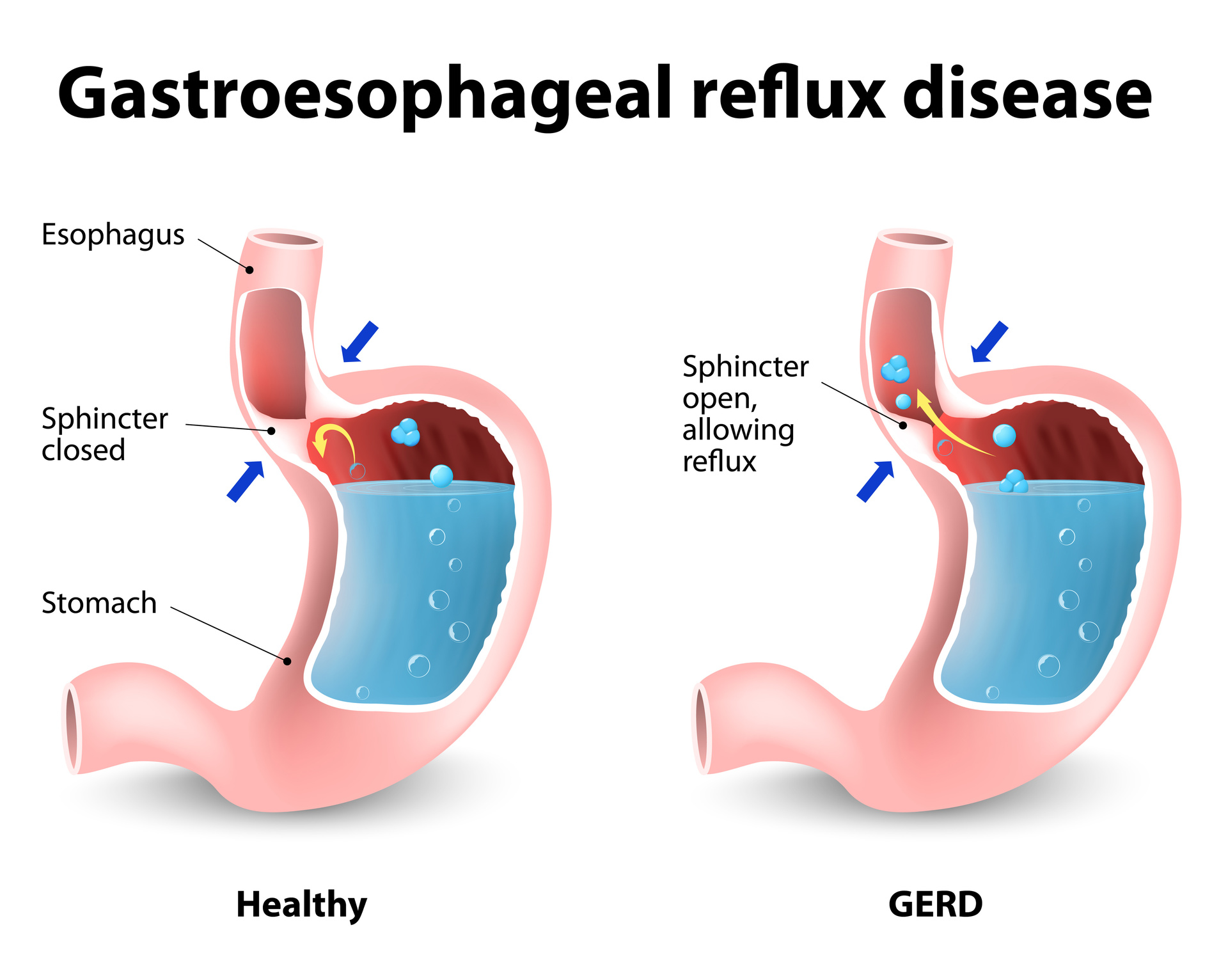 This is a chronic disease that occurs when stomach acid or bile flows into the food pipe and irritates the lining.