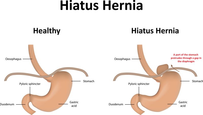 Hiatal Hernia | Advanced Alternative Medicine Center I ...